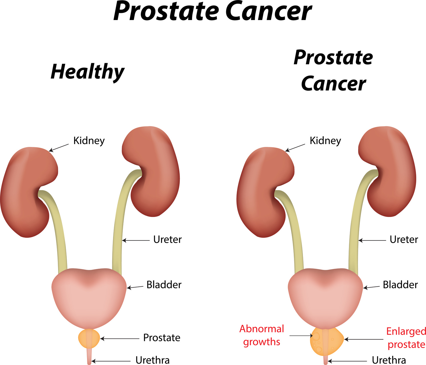 Prostate Cancer diagram