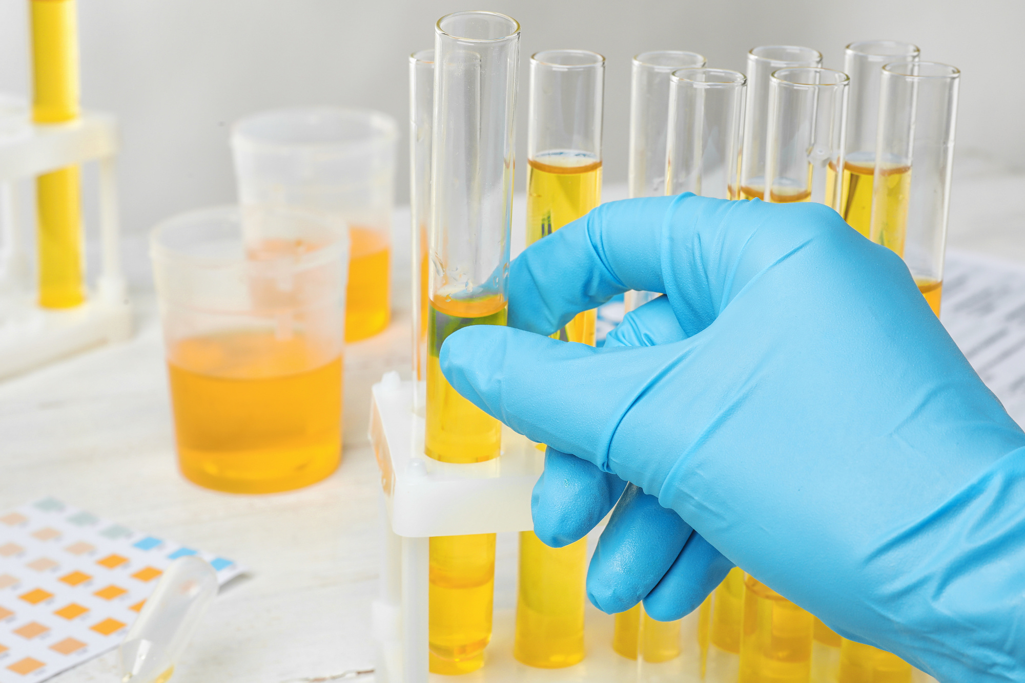 A lab tech analyzing urine color in test tubes | Urology Associates | Denver, CO